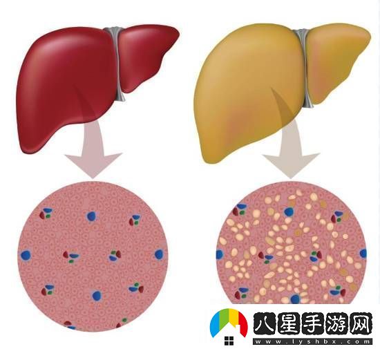 大學生月瘦20斤卻患上脂肪肝